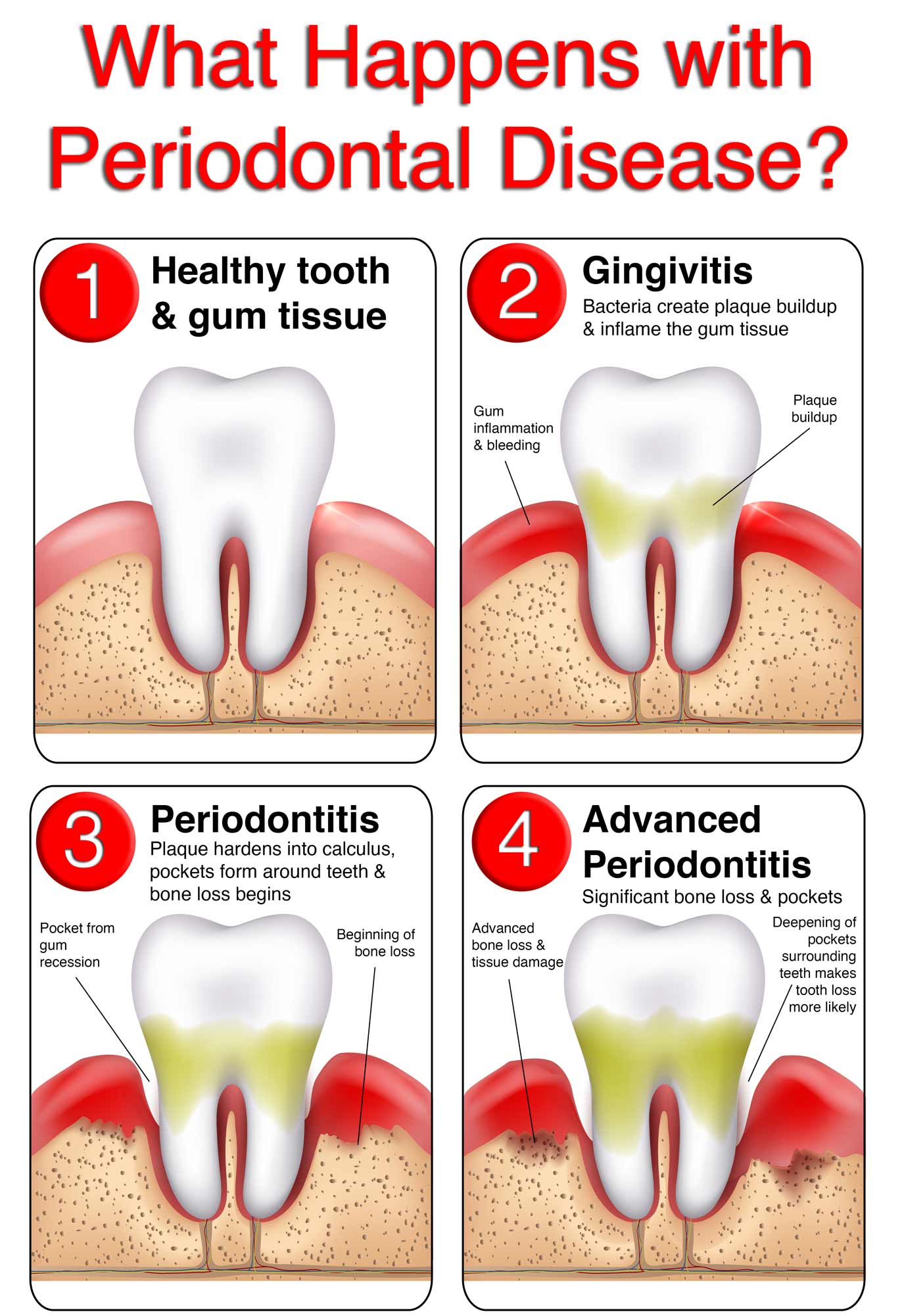 Periodontal Disease Chart